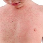 Rash children hives rashes kids common childhood treatment